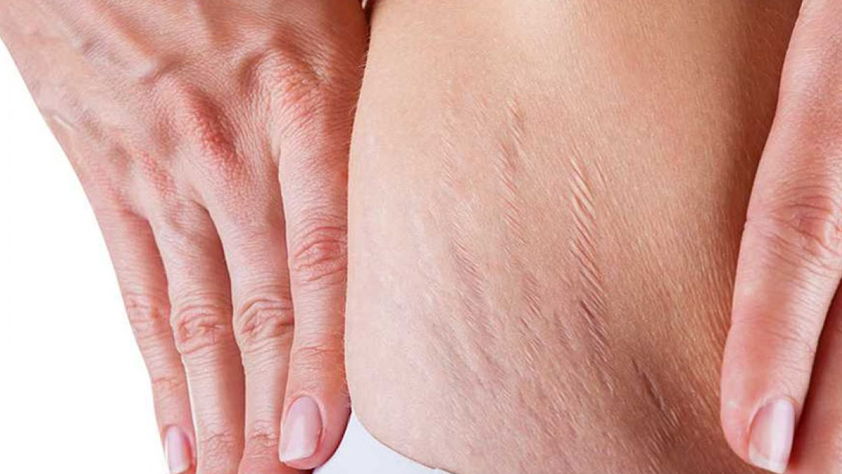 Çatlaklara Karşı Doğal Yaklaşımlar ve Yaşam Tarzı Tüyoları