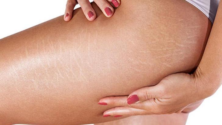 Çatlaklara Karşı Doğal Yaklaşımlar ve Yaşam Tarzı Tüyoları