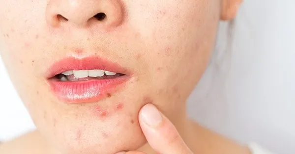 Cilt Sorunlarına Doğal Çözümler: Sivilce, Güneş Lekesi ve Mor Halkalar İçin Pratik Yöntemler