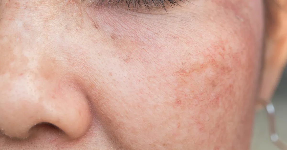 Cilt Sorunlarına Doğal Çözümler: Sivilce, Güneş Lekesi ve Mor Halkalar İçin Pratik Yöntemler