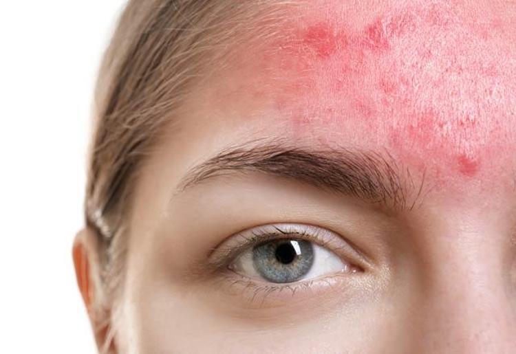 Cilt Sorunlarına Doğal Çözümler: Sivilce, Güneş Lekesi ve Mor Halkalar İçin Pratik Yöntemler