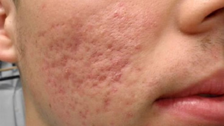 Cilt Sorunlarına Doğal Çözümler: Sivilce, Güneş Lekesi ve Mor Halkalar İçin Pratik Yöntemler