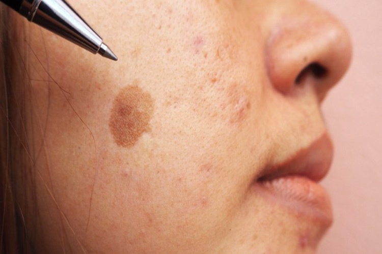 Güneş Işınları, Deri Sağlığı ve Enfeksiyon Direnci: Bilinçli Güneş Kullanımı