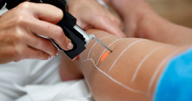 Kıl Köklerine Odaklanan Lazer Epilasyon Rehberi: Alexandrite, ND YAG, Diode Next ve Soprano Buz