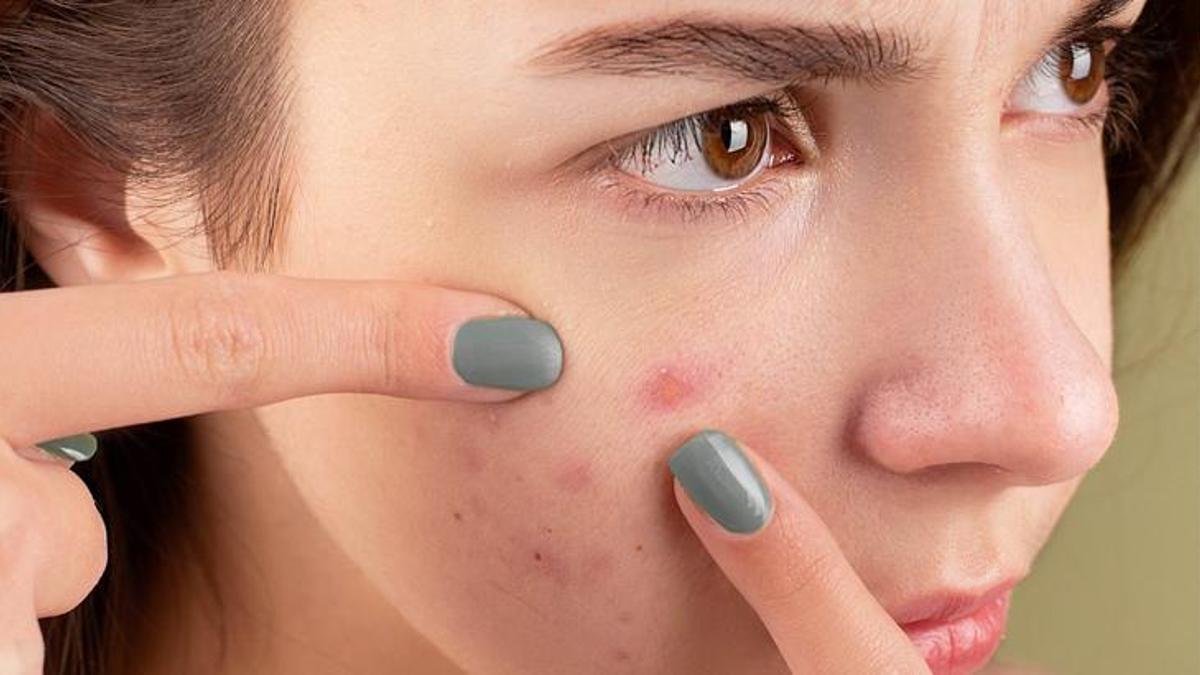 Yüz ve Vücut Sivilceleri: Bölgelere Göre Nedenler ve Çözüm Önerileri