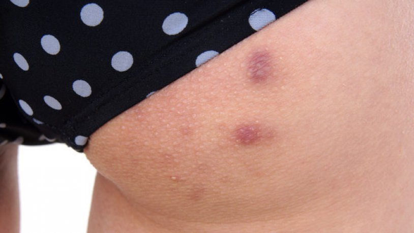 Yüz ve Vücut Sivilceleri: Bölgelere Göre Nedenler ve Çözüm Önerileri