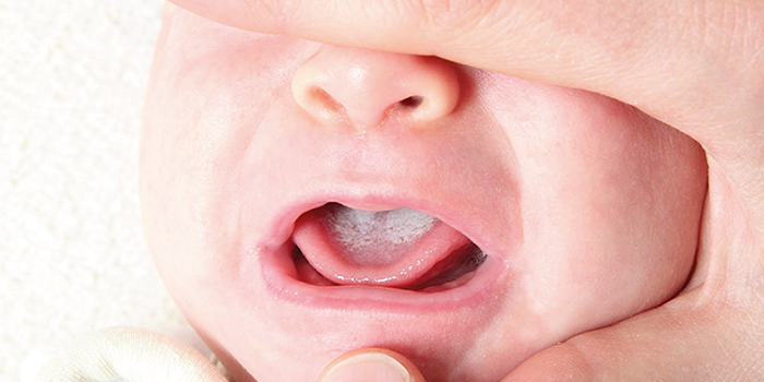 Bebeklerde Pamukçuk: Belirtiler, Nedenler ve Pratik Tedavi Yöntemleri